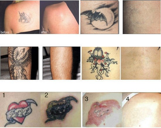 remoção machine-treatment.jpg da tatuagem